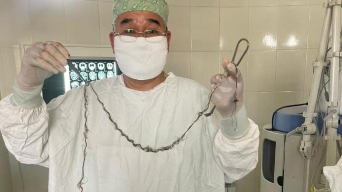 Kirgizistanda kucuk kizin 8 yil boyunca beyninde buyuyen saci ameliyatla